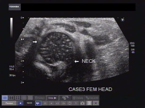 Cochinblogs Ultrasound Imaging Of The Head Of Neonatal Femur And Humerus