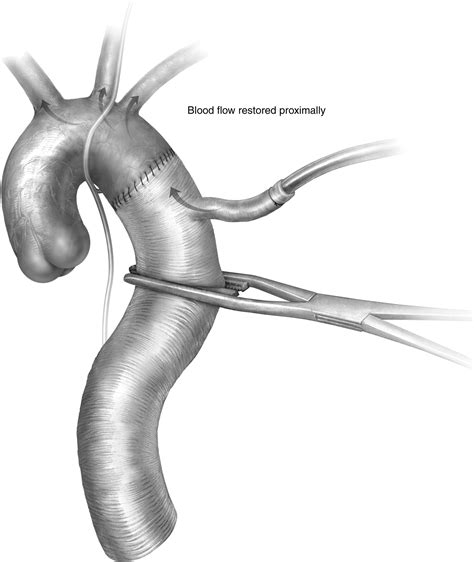Operative Repair Of Type B Aortic Dissection Operative Techniques In