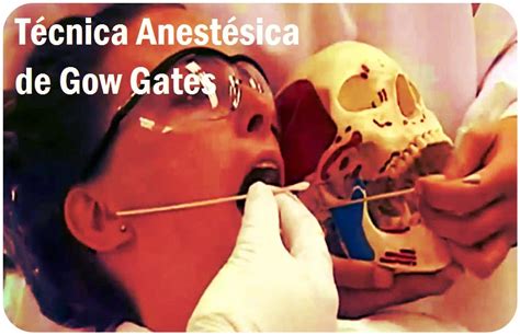 Anestesia Dental Técnica Anestésica De Gow Gates Odonto Tv