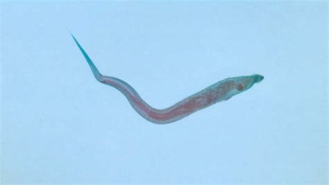 Pinworms Infection Causes Symptoms Treatment Prevention