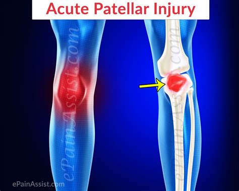 Acute Patellar Injury Read Sports Injuries