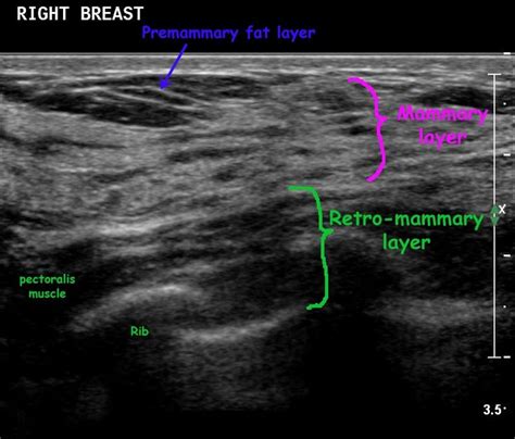 Normal Breast Ultrasound Breast Ultrasound Sonography Thyroid