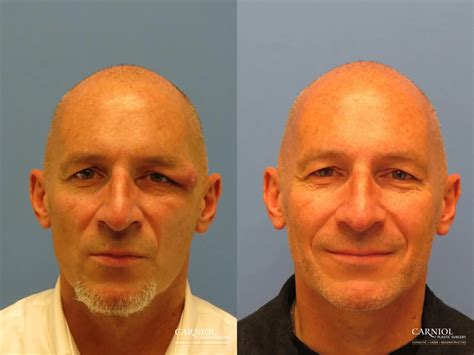 Eyelid Surgery Before And After Gallery