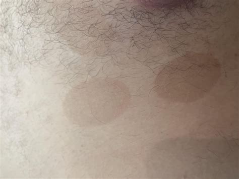 Spots On Chest Does Anyone Know What It Could Be Not Itchy At All And