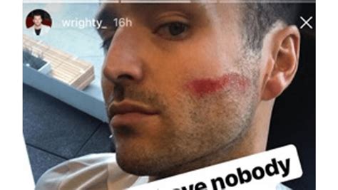 Mark Wright Injured At The Gym 8 Days