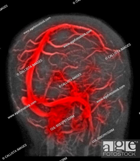 Normal Brain Mri Magnetic Resonance Venography Stock Photo Picture