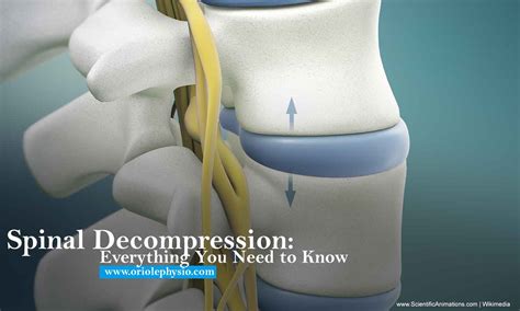 Spinal Decompression Everything You Need To Know Oriole