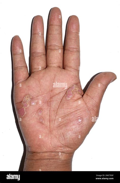 Desquamation Or Peeling Skin Of Hand Due To Dermatitis Itchy Palm