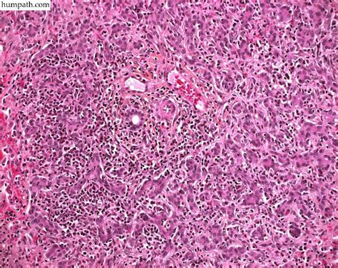 Looking for online definition of necrosis in the medical dictionary? massive hepatic necrosis - Humpath.com - Human pathology
