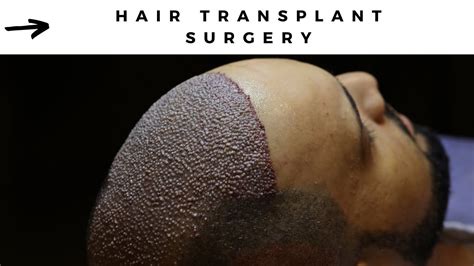 Hair Transplant Surgery And After Now Hair Time Youtube