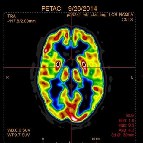 Pet Ct Scan Brain - ct scan machine