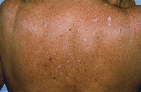Lichen Sclerosus Causes Symptoms Treatment
