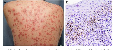 Pdf A Secondary Syphilis Rash With Scaly Target Lesions Semantic