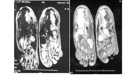 T1 Weighted Axial Magnetic Resonance Imaging Mri Of The Feet Showing