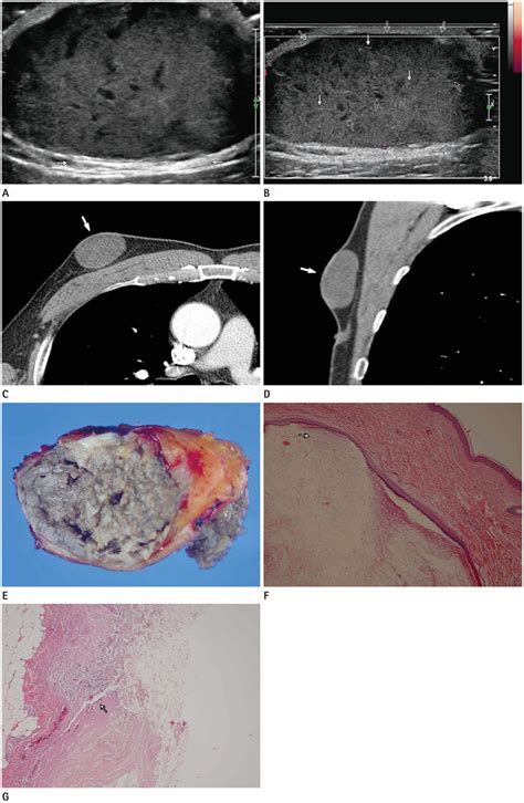 Giant Epidermal Inclusion Cyst In The Male Breast A Case Report