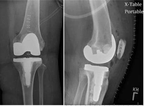 Postoperative Radiographs Of Case 1 Showing A Well Fixed And Aligned