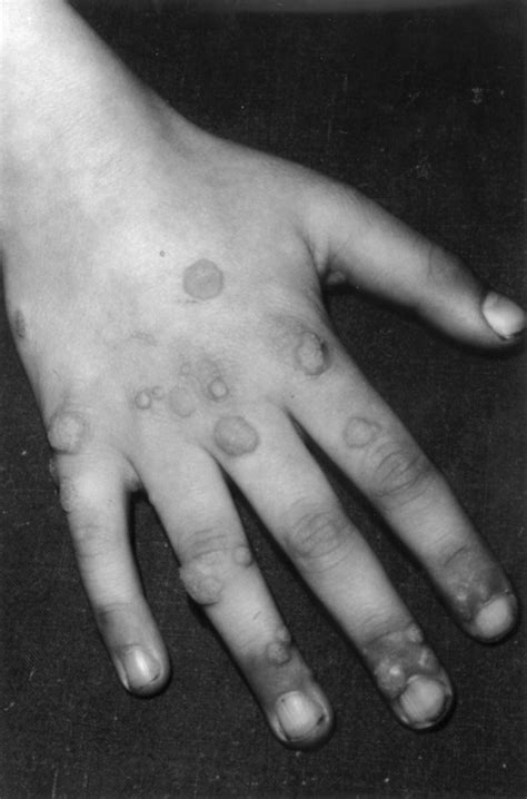 How To Manage Warts Archives Of Disease In Childhood