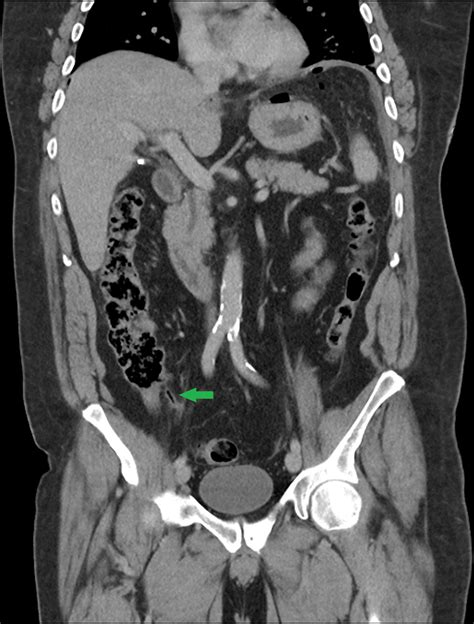 Initial Ct Scan Of The Abdomen On Presentation Green Arrow