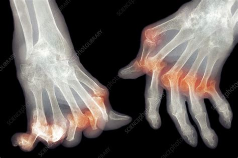 Arthritic Hands X Ray Stock Image M1100511 Science Photo Library