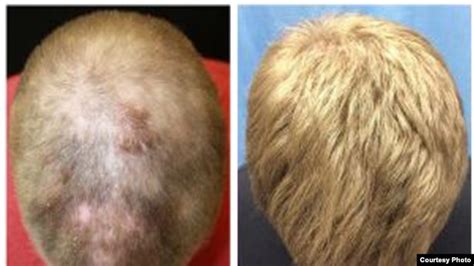 Arthritis Drug Spurs Hair Growth On Bald Mans Head