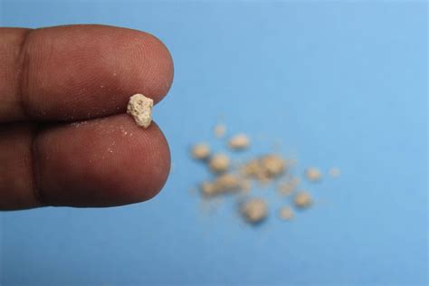 Kidney stones are more common than ever. flat lay or top view very small kidney stone at two finger ...