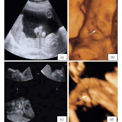 Pdf Prenatal Diagnosis Of Fetal Cleft Lip And Palate With Three