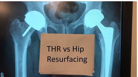 Difference Between Hip Resurfacing And Total Hip Replacement Youtube