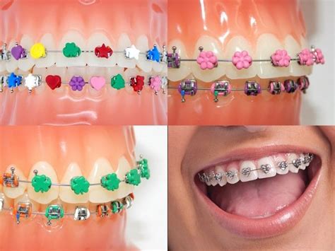 Colorful Teeth Braces Ideas Be Irresistible And Make A Fashion Statement With Images