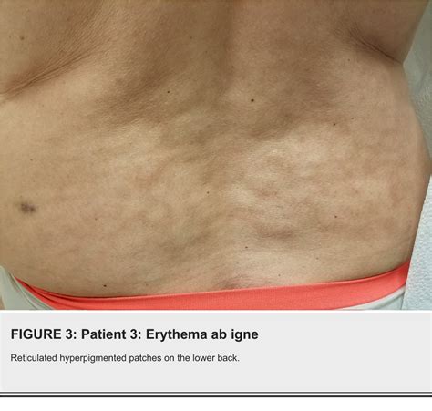 Pdf Erythema Ab Igne From Heating Pad Use A Report Of Three Clinical