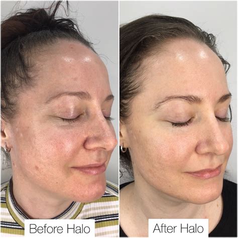 Halo Laser Treatment In Brisbane Jade Cosmetic Clinic