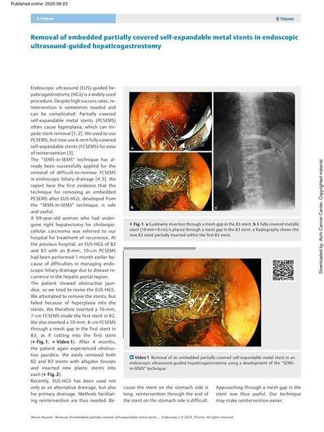 PDF Removal Of Embedded Partially Covered Self Expandable Metal