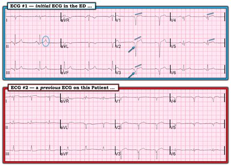 Dr Smiths Ecg Blog Is This New Lad Occlusion With St Elevation