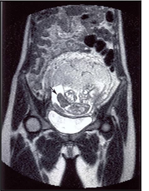 figure 1 from ultrafast magnetic resonance imaging of omphalopagus conjoined twins semantic