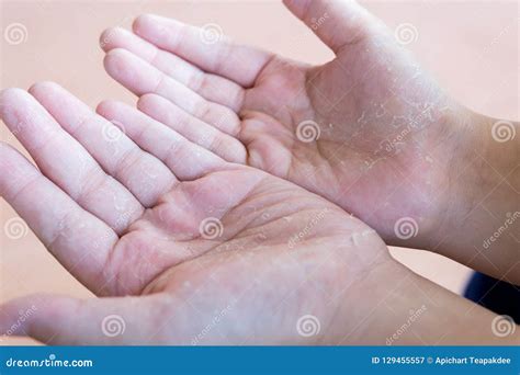 Skin Peeling Due Stock Image Image Of Care Medicine 129455557