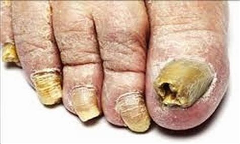 Fungal Nail Infection29