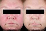 Images of Rosacea Treatment Topical Medications