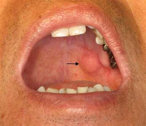 Carcinoma Ex Pleomorphic Adenoma Of Soft Palate With Cavernous Sinus