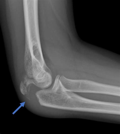 Cureus Bilateral Asynchronous Displaced Olecranon Fractures In A