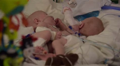 Successfully Separated Conjoined Twins New Hope