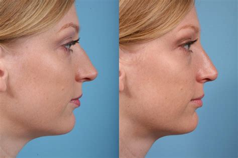 Rhinoplasty Before And After Photos Patient 18 Chicago Il Tlkm