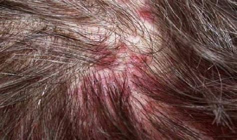 Red Itchy Bumps On Scalp