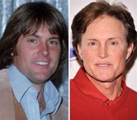 Bruce Jenner Plastic Surgery Before And After Facelift With Images Celebrity Plastic