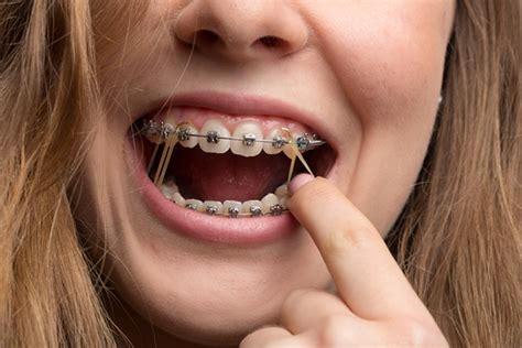 Soft foods are highly recommended after the first few days of getting your braces. Interarch elastics are important to a successful ...