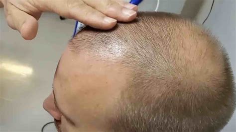 Review Of Stem Cell Hair Transplant For Baldness The Niche