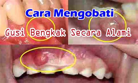 Cara Mengobati Gusi Bengkak Dengan Cepat Dan Alami - Dunia ...