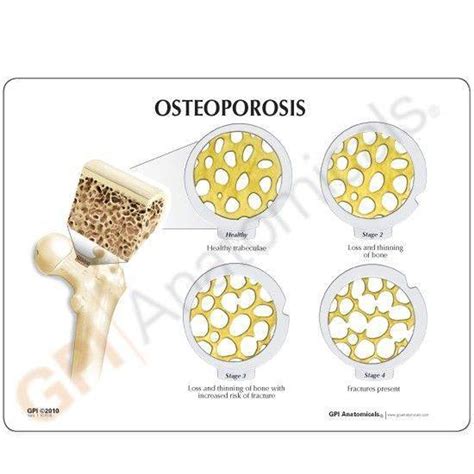 Anatomy Model Osteoporosis 4 Stage