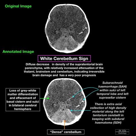 White Cerebellum Sign Medical Radiography Radiology Neurology
