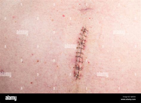 Epigastric Hi Res Stock Photography And Images Alamy