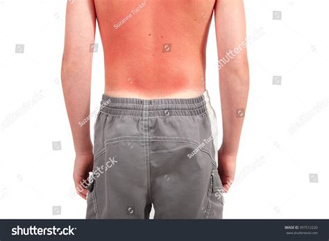 Burn Back Images Browse 20382 Stock Photos And Vectors Free Download
