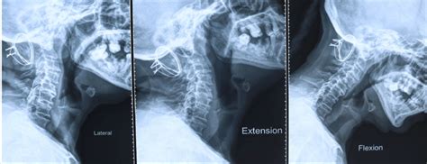 Dynamic X Ray Of The Cervical Spine And Cvj Showing Good Bony Fusion